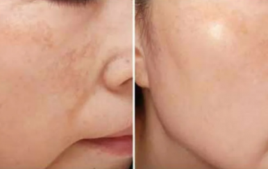 都說祛斑難，對(duì)不起，那是他因?yàn)槟銢]選對(duì)方法！